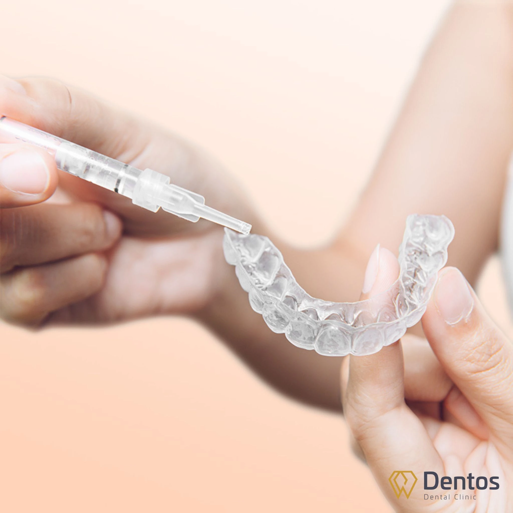 Tẩy trắng răng tại nhà phù hợp cho răng nhiễm màu mức độ nhẹ